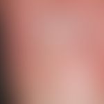 Onychodystrophy: apparently single damage (local event because transverse grooves are formed only...