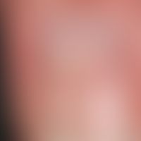 Onychodystrophie: offenbar einmalige&nbsp;Schädigung (lokales Ereignis da&nbsp;Querrillenbildung ...