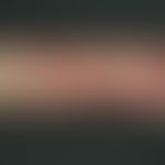 Purpura: trauma-induced older and fresh skin bleeding, in a 68-year-old patient with bronchial as...