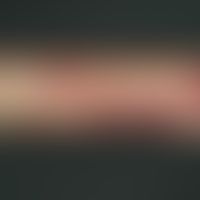 Purpura: trauma-induced older and fresh skin bleeding, in a 68-year-old patient with bronchial as...