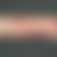 Steroidpurpura: traumatisch bedingte ältere und frische Hautblutungen, bei einem 68 Jahre alten P...