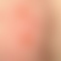 Bubbles: different sized bulging (subepithelial) bubbles on flat erythema (bullous pemphigoid)
