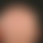 Alopecia areata totalis: complete loss of hair on the capillitium and eyebrows except for a few r...