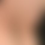 Alopecia areata totalis:complete loss of hair on the capillitium, eyebrows, body hair, here loss ...