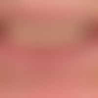 Cheilitis actinica chronica: uniform, laminar leukoplakia of the upper and lower lip with a tende...