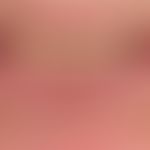 Cheilitis actinica chronica:&nbsp;flächige Leukoplakie an Unter- und Oberlippe durch chronische U...