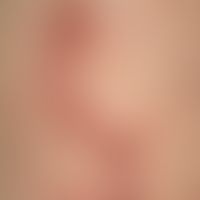Ulzera der Haut: multiple rundliche Ulzera, streifig angeordnet, bei "Perforierender Kollagenose"...
