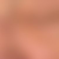 Xanthelasma:&nbsp;die Hautläsionen entwickelten sich allmählich innerhalb der vergangenen 3-4 Jah...