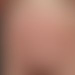 Erythema gyratum repens: chronically dynamic (changeable course since 6 months), increasingly anu...