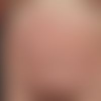 Erythema gyratum repens: chronically dynamic (changeable course since 6 months), increasingly anu...
