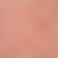Urticaria pigmentosa: classic form of Urticaria pigmentosa (type I), disseminated, flat, oval or ...