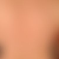 Varicella: generalized, but only moderately pronounced (no feeling of illness) exanthema with a c...