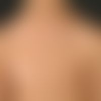 Vitiligo: several large, bizarrely configured white patches.

