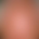 Lentigo solaris: multiple, disseminated, a few millimetres to 1.5 centimetres in size, oval, roun...