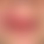 Schwere chronische Cheilitis bei bekanntem Melkersson-Rosenthal-Syndrom. Chronische Schwellung de...