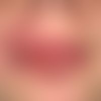 Severe chronic cheilitis with known Melkersson-Rosenthal syndrome, chronic swelling of the lips w...