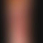 pyodermic ulcer of the skin: moderately deep, large ulcer; characteristic are the circulatory (as...