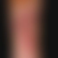 pyodermic ulcer of the skin: moderately deep, large ulcer; characteristic are the circulatory (as...