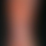 pyodermic ulcer of the skin: moderately deep, large ulcer; characteristic are the circulatory (as...