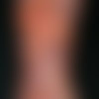 pyodermic ulcer of the skin: moderately deep, large ulcer; characteristic are the circulatory (as...