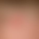 Basal cell carcinoma nodular: probably existing for years, slowly growing, skin-coloured, bumpy, ...