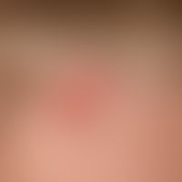 Basal cell carcinoma nodular: probably existing for years, slowly growing, skin-coloured, bumpy, ...