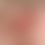 Knot skin-coloured smooth: Flat, humped, skin-coloured knot with smooth surface Diagnosis: Nodula...