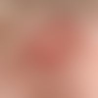 Knot skin-coloured smooth: Flat, humped, skin-coloured knot with smooth surface Diagnosis: Nodula...