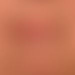 Atrophy, senile: age-related involution of the skin of the lips with pronounced radial furrow for...