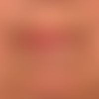 Atrophy, senile: age-related involution of the skin of the lips with pronounced radial furrow for...
