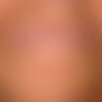Combined intrinsic and extrinsic involution of the lip skin with radial and rhomboidal furrow for...