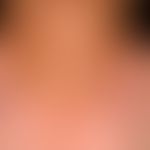 Vitiligo: therapy-induced (after administration of a checkpoint inhibitor) vitiligo in a patient ...