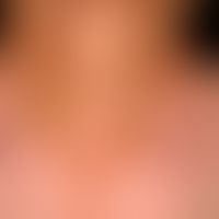 Vitiligo: therapy-induced (after administration of a checkpoint inhibitor) vitiligo in a patient ...
