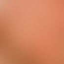 Selbstbräuner: ungleichmäßige Braunfärbung der Wangenpartie nach Auftragen eines selbstbräunenden...