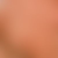 Self-tanner: uneven browning of the cheek area after application of a self-tanning external layer.
