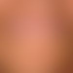 Elastosis actinica. Tiefe radiäre Falten und wulstiges, rhomboidales Hautrelief der Kinnreegion b...