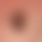 basal cell carcinoma nodular: centrally ulcerated basal cell carcinoma. the diagnosis is recogniz...