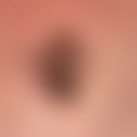Basalzellkarzinom knotiges: zentral ulzeriertes Basalzellkarzinom. Die Diagnose ist an den randli...