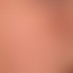 Teleangiectasia macularis eruptiva perstans. Seit Jahren langsam progrediente "Hautrötung" aus di...