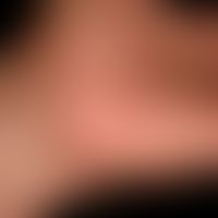 Teleangiectasia macularis eruptiva perstans: for years slowly progressive "skin redness" on the t...