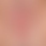 Lichen sclerosus et atrophicus: massive infestation of the vulva with bulging sclerosing of the l...