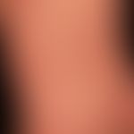 urticaria chronic spontaneous: multiple, chronically recurrent, reddish, sometimes confluent whea...