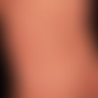Urtikaria&nbsp;chronische spontane:&nbsp;multiple, chronisch rezidivierende, rötliche, teils konf...