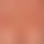 Urticaria chronic spontaneous: relapsing clinical picture with multiple, acute, reddish, confluen...