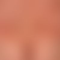 Urticaria chronic spontaneous: relapsing clinical picture with multiple, acute, reddish, confluen...