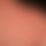 urticaria chronic spontaneous: multiple, chronically recurrent, reddish, confluent wheals. severe...