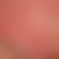 urticaria acute spontaneous: multiple, acutely occurring, reddish, confluent wheals. severe itchi...