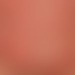 Urticaria acute spontaneous: multiple, acutely occurring, reddish, confluent wheals.severe itchin...
