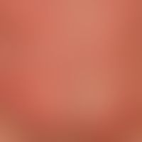 Urticaria acute spontaneous: multiple, acutely occurring, reddish, confluent wheals.severe itchin...