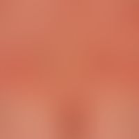 Urticaria chronic spontaneous: multiple, chronically recurrent, red, partly confluent wheals; sev...